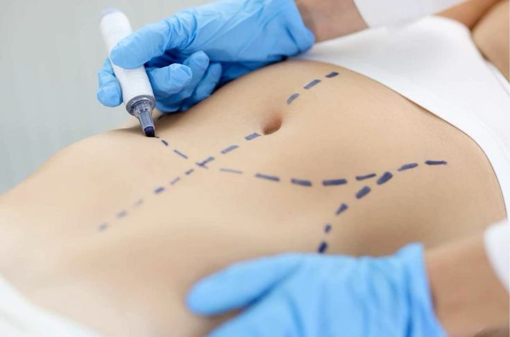 La Chirurgie Bariatrique